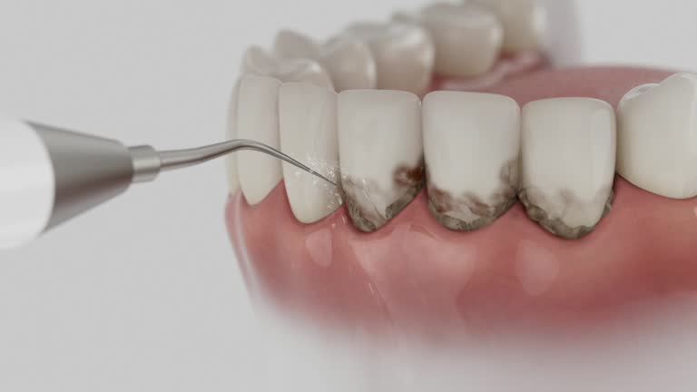 Trusted Wisdom Tooth Removal service in Kingsford Heights, IN - Dentist Open Now